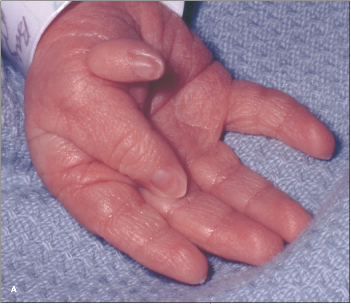 Polydactyly of the Hand Consultant360